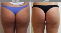 Az alakformálás legújabb lehetősége: Body Shaping program/ VelaSmooth és a meridián kezelés ötvözése 1.kép Az alakformálás legújabb lehetősége: Body Shaping program/ VelaSmooth és a meridián kezelés ötvözése 1.kép