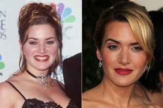 Kate Winslet néhány éve még ellenezte a plasztikát …