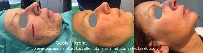 Volumenpótló és rejuvenáló hatása is van a modern, Microfat technikával végzett zsírátültetésnek