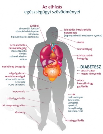 A túlsúly nem csupán esztétikai probléma, számos betegségnek az előcsarnoka 3.kép