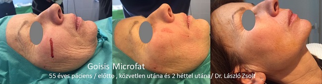 Saját zsír áttöltés Giosis módszerrel (csípő tájékról zárt rendszeren keresztül az arcba)