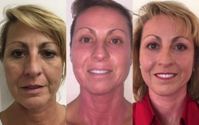 Hideg lézeres plazma bőrfiatalító hatása teljes arcra/ Cool plasma laser forgalmazójának fotója:lookyounger.news Hideg lézeres plazma bőrfiatalító hatása teljes arcra/ Cool plasma laser forgalmazójának fotója:lookyounger.news