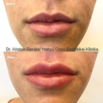 Ajakfeltöltés - Dr. Kriston Renáta/ Hattyú Orvos Esztétikai Klinika Ajakfeltöltés - Dr. Kriston Renáta/ Hattyú Orvos Esztétikai Klinika