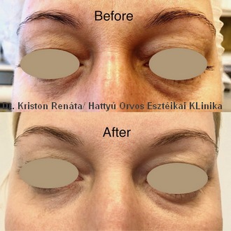 Szem alatti barázda térfogatpótlása - Dr. Kriston Renáta/ Hattyú Orvos Esztétikai Klinika Szem alatti barázda térfogatpótlása - Dr. Kriston Renáta/ Hattyú Orvos Esztétikai Klinika