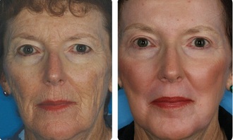 Fenolos peeling lehetséges eredménye Fenolos peeling lehetséges eredménye