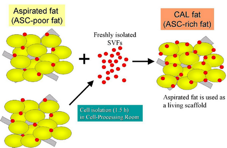Zsírleszívás utáni sajátzsír bio-aktiválása saját SVF faktorral= innovatív zsírátültetés (CAL)