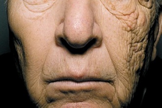A bal arcfelet (képen jobb) erős napsugárzás érte 28 éven keresztül, a másik oldal védve volt