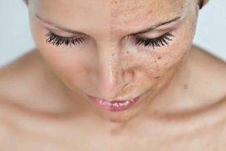 anti aging bőrkezelés kémiai hámlasztás uborkás arcpakolás