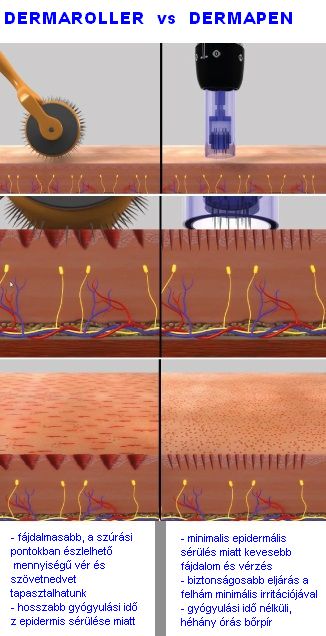 DERMAPEN vs DERMAROLLER - hasonlóságok, különbségek  2.kép
