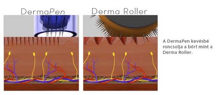 DERMAPEN vs DERMAROLLER - hasonlóságok, különbségek  4.kép