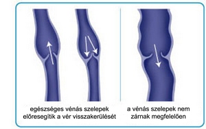 új technológiák a visszér kezelésére)