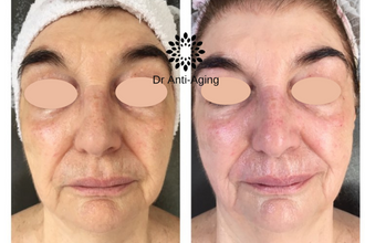 1 kezelés eredménye: 3 lépcsős tisztítás+ egyénre szabott szérumkomb.+ DrAntiAging Arclifting + Nyaki-Háti Masszázs 1 kezelés eredménye: 3 lépcsős tisztítás+ egyénre szabott szérumkomb.+ DrAntiAging Arclifting + Nyaki-Háti Masszázs