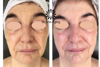 1 kezelés eredménye: 3 lépcsős tisztítás+ egyénre szabott szérumkomb.+ DrAntiAging Arclifting + Nyaki-Háti Masszázs   