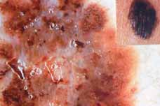 melanoma , a halálos kimenetelű bőrrák dermatoszkópos képe melanoma , a halálos kimenetelű bőrrák dermatoszkópos képe