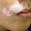 Vitiligos arc Vitiligos arc