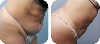 BodyTite™ zsírleszívás bőrfeszesítéssel - elért eredmény (Dr. Mullholland) 