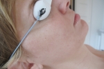 Aknes arcbőr ELOS kezelése