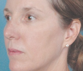 5 Triniti kezelés után 2 hónappal a megfiatalodott arc