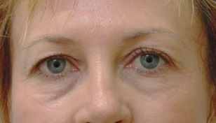 5 triniti kezelés után a szemkörnyéke teljesen megfiatalodik