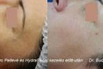 HydraFacial és Pelleve kezelések 