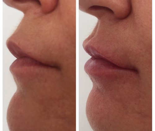 DUO-ajakfiatalítás: MD kollagén + HA Lips/ kezelés előtt és a 2. alkalom után azonnal