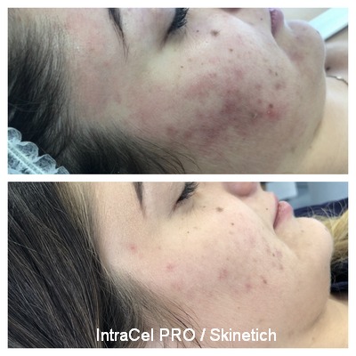 INTRAcel PRO - mikrotűs RF rejuvenáció 