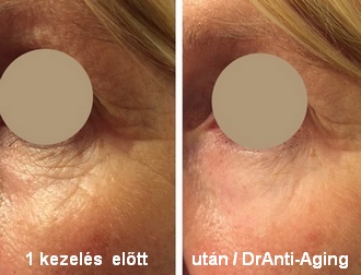 bőrhatások anti aging szem kezelés
