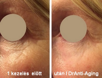 legjobb anti aging szem alatti kezelés