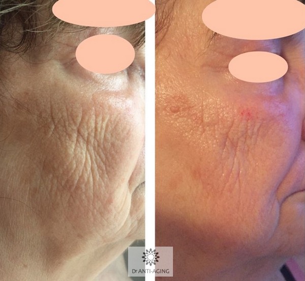 76 éves nő: Mezopen + UH+RF+EMS+ LED+ Biolifting+Janssen prof. kozmetikumok 1. alk előtt és után