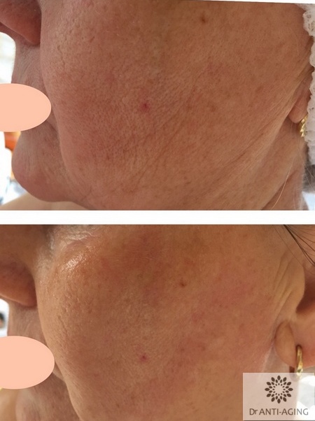 55 éves érzékeny bőrű nő: Mezopen + UH+RF+EMS + Biolifting +Janssen prof. kozm. 1. alk előtt és után
