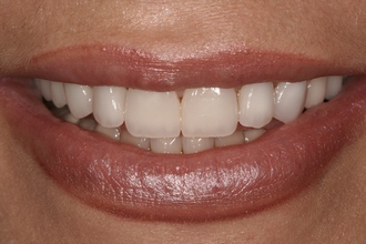 un. teljes száj helyreállitás funkcionális smiledesign-nal, ahol az állkapocsizületi szempontok (fun