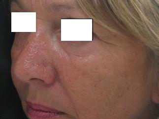 Dermaroller kezeléssor utáni arcfiatalodás