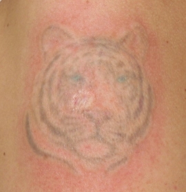 4.kezelés után, a színes tetoválásokhoz többszöri kezelésre van szükség