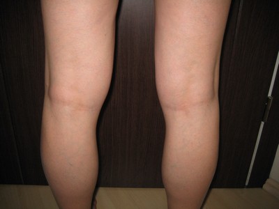 Velashape kezelés előtt látható térd körüli zsírfelesleg, cellulitos bőr