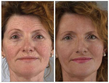 Teljes arc ránctalanítása BioSkinJetting módszerrel / forrás: Pascaud Beauty Innovation