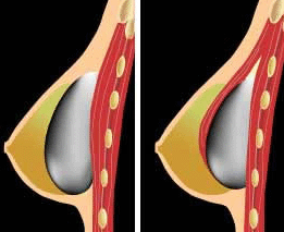 Implantátum elhelyezkedése: mirigyállomány alatt, v. félig a mellizom mögött