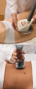 VelaShape kezelések 2 féle kezelőfejjel történnek VelaShape kezelések 2 féle kezelőfejjel történnek
