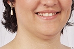 Toka kezelés előtt Toka kezelés előtt