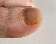 mi kenőcs van szükség a kezelés a köröm gomba dermatitis köröm gomba