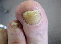 a körömfungus intelligens zománcja van nail foot fürdők a körömgomba ellen