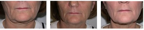50 év feleletti hölgy arconásainak változtása a Thermage™ kezelés után azonnal és 3 hónappal később