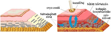 Változások a bőrben a rádiófrekvenciás kezelés hatására 
