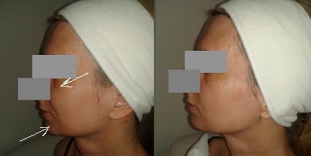 Face Lifting Kombinált kezelés eredményessége 1. alk. után/ Wellmed Beauty Medical Spa saját fotója