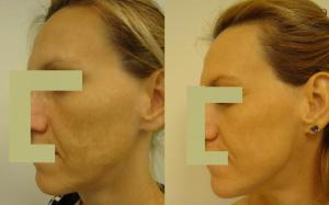 Pigmentfoltos arc 2 alkalom BBL kezelés után/ Dr. Kolat Zsuzsanna