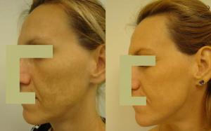 Pigmentfoltos arc 2 alkalom BBL kezelés után/ Dr. Kolat Zsuzsanna Pigmentfoltos arc 2 alkalom BBL kezelés után/ Dr. Kolat Zsuzsanna