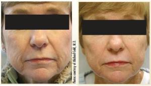 ProFractionalLaser bőrfeszesítő kezelés előtt-után ProFractionalLaser bőrfeszesítő kezelés előtt-után