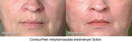 CounturPeel bőrfeszesítő és bőrmegújító kezelés CounturPeel bőrfeszesítő és bőrmegújító kezelés