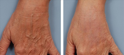 Komplex kézfej fiatalítás: pulzáló fényterápia és hialuronsavas feltöltés 2.kep