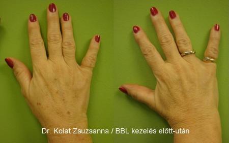 Komplex kézfej fiatalítás: pulzáló fényterápia és hialuronsavas feltöltés 3.kep