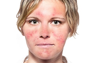 rosacea kezelése